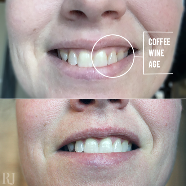 crest teeth whitening strips before and after