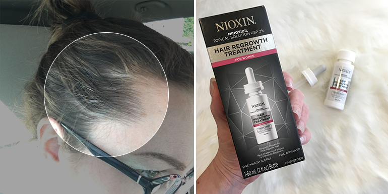 90 day nioxin challenge remaking june