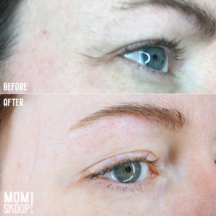 Non-Surgical Eye Lift before after