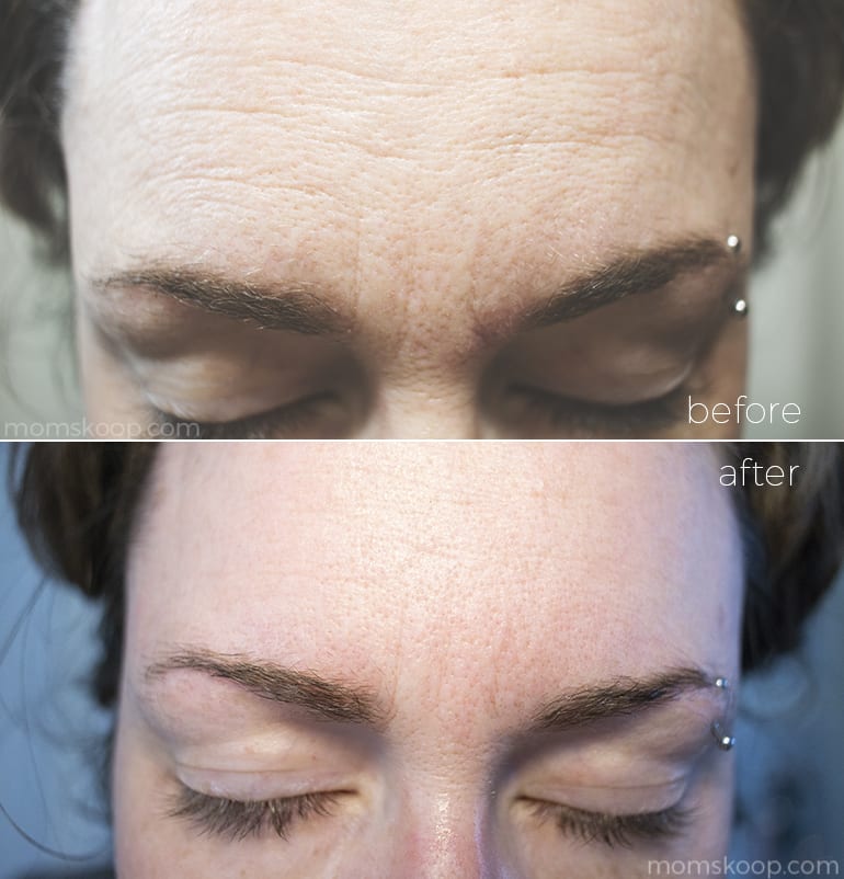 SkinPro BIO-Placenta Revitalizing Serum before and after