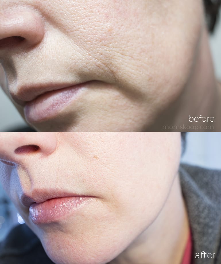 SkinPro BIO-Placenta Revitalizing Serum before and after