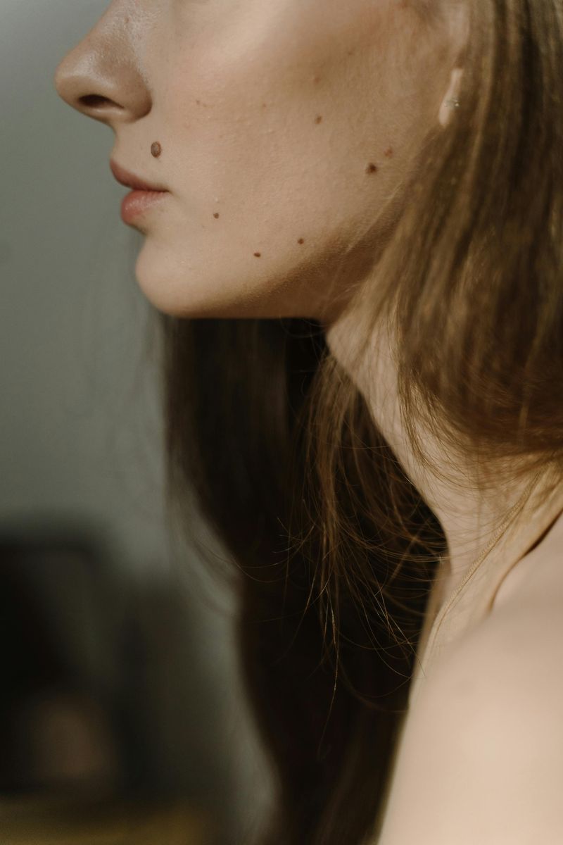 Moles and Birthmarks