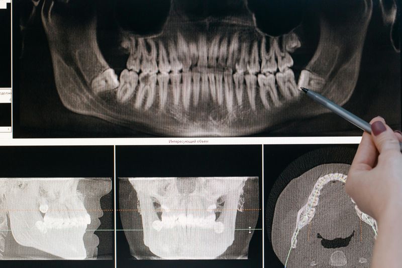 An Absence Of Wisdom Teeth