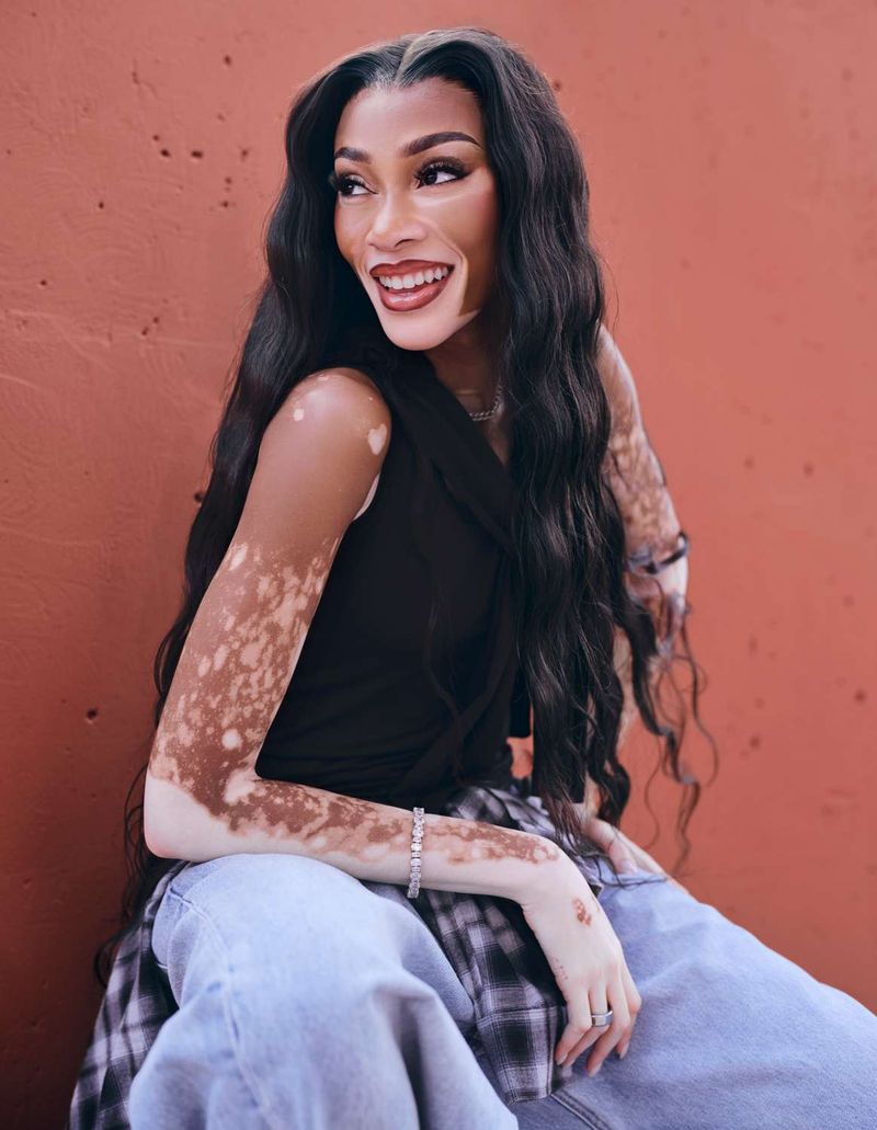 Winnie Harlow – Vitiligo