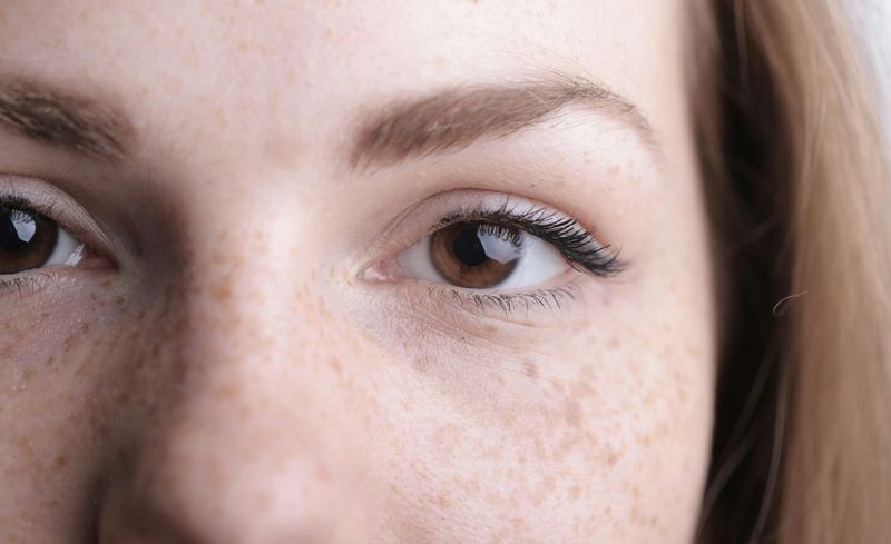 Freckles