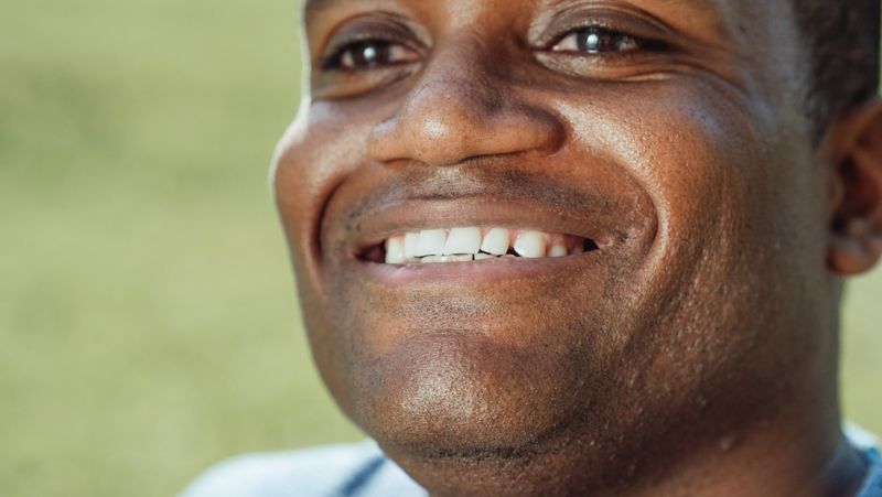 Smile Lines and Wrinkles