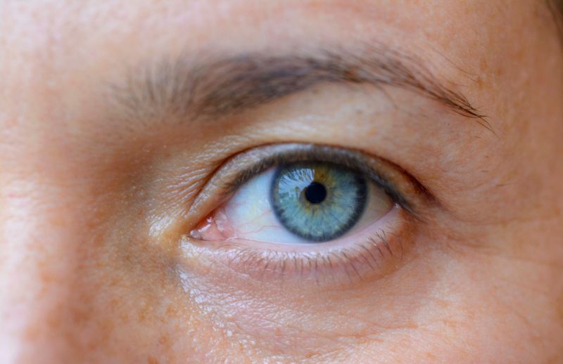 Drooping Eyelids