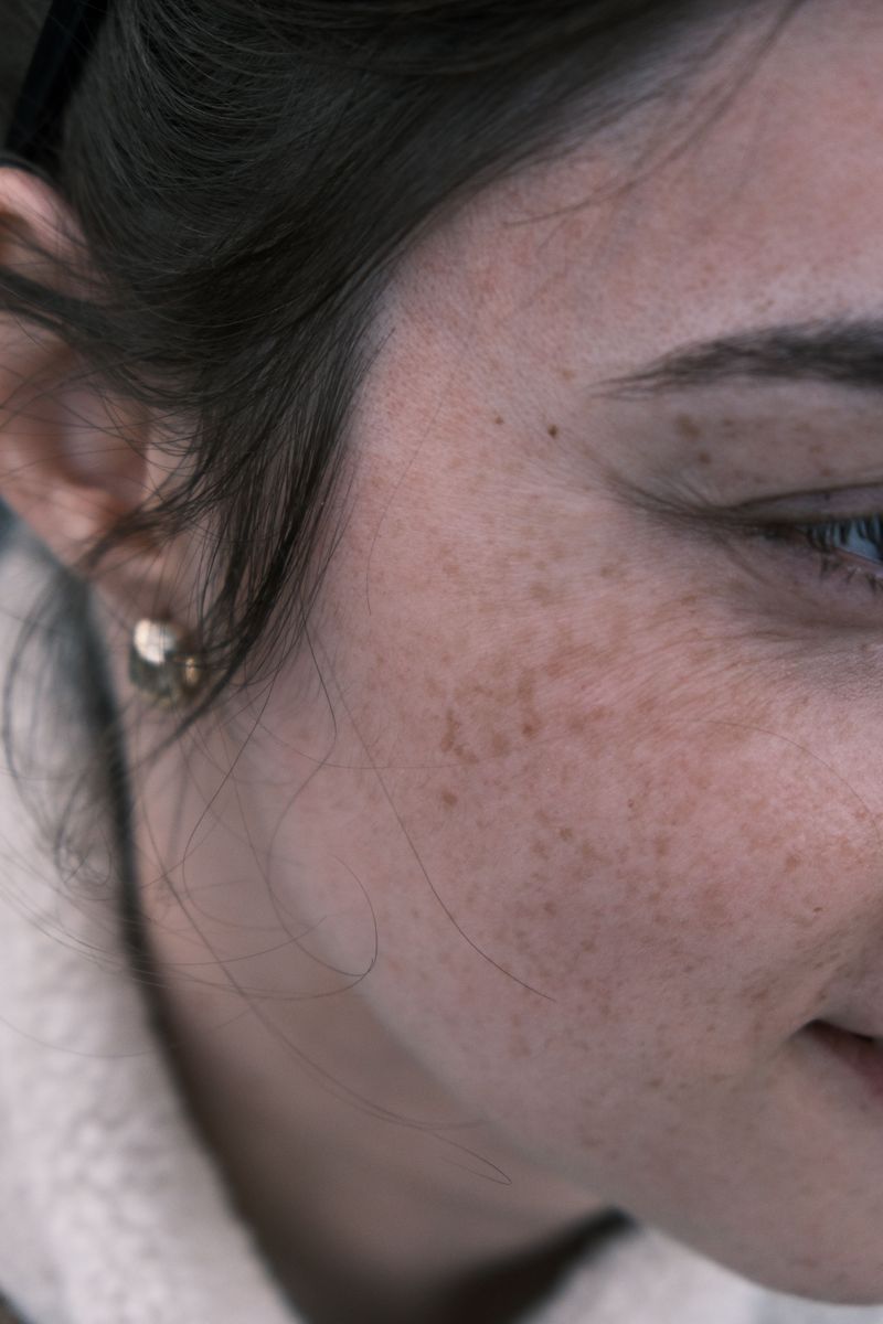 Uneven Skin Tone