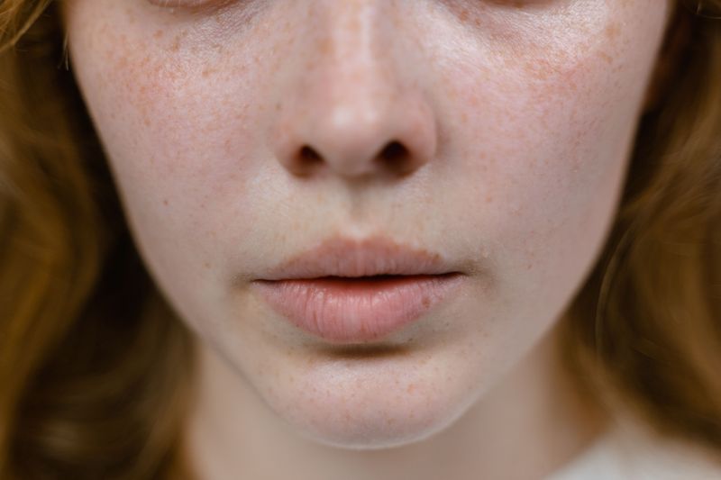 Age Spots and Freckles