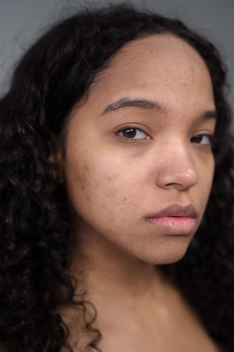 Uneven Skin Tone and Discoloration
